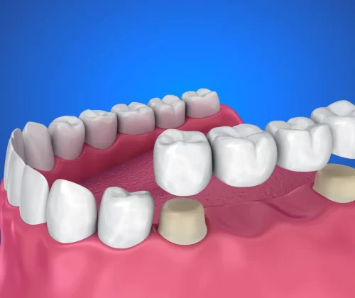 Annerley Dental crowns and bridges treatment